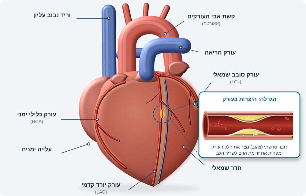 איור 1: עורקי הלב (העורקים הכליליים) והיצרות הנגרמת מרובד טרשתי