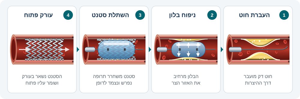 איור 4: שלבי הטיפול בהיצרות (PCI) – חוט, בלון וסטנט